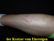 Kratzer am Schienbein